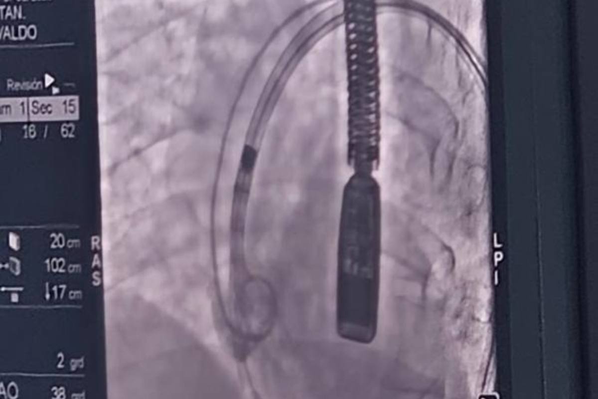 implante de válvula aórtica transcatéter. Nuevo Hospital San Roque